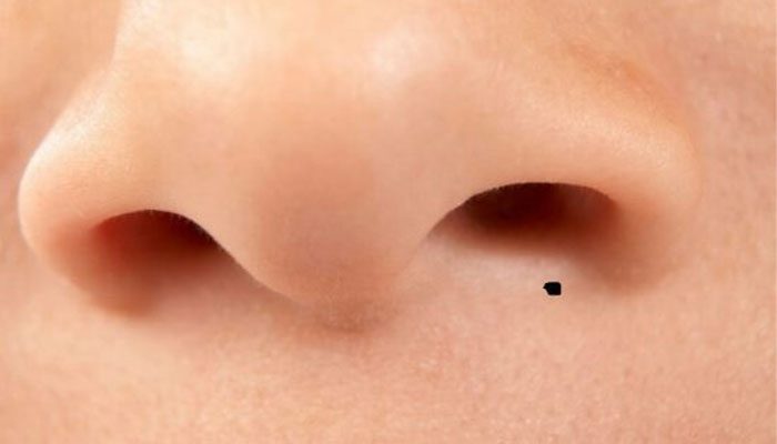 Nốt Ruồi Ở Dưới Mũi Có Ý Nghĩa Gì?