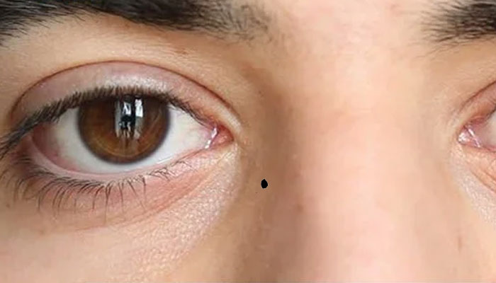 Nốt ruồi ở mũi mang ý nghĩa đặc biệt