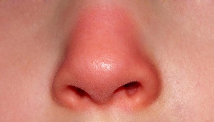 Mũi Cà Chua Là Người Như Thế Nào?