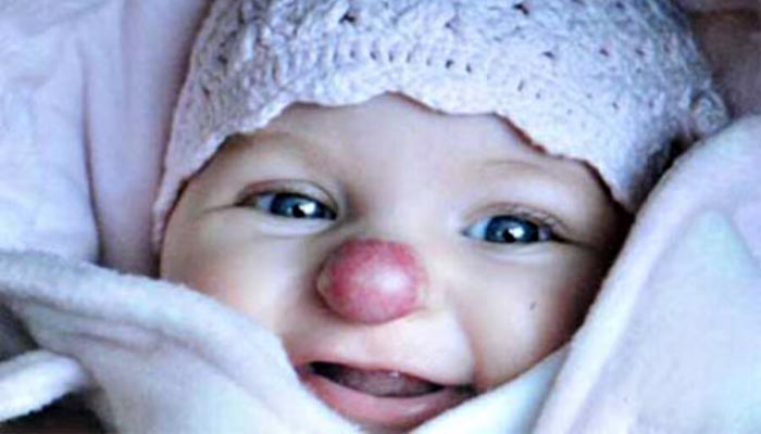 Xem tướng mũi cà chua