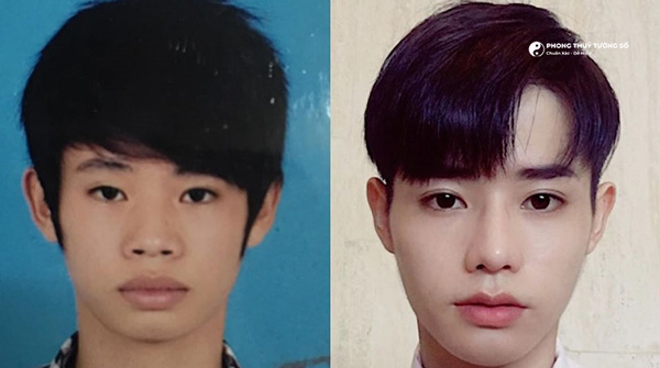 Hình ảnh một người sau khi sửa khuyết điểm mũi bị hếch của mình