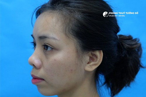 Góc nghiêng của người mũi hếch