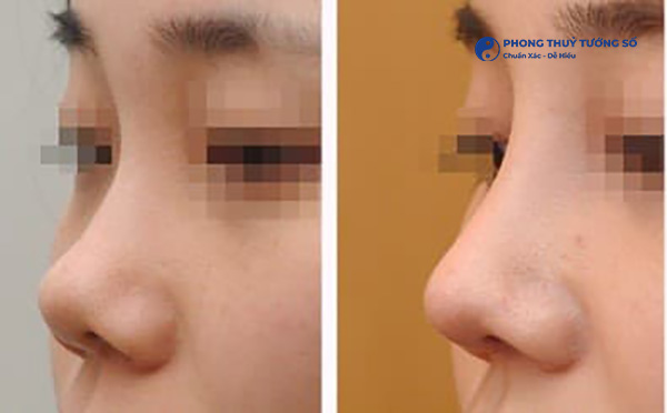 Dáng mũi hỉnh nhìn ở góc nghiêng