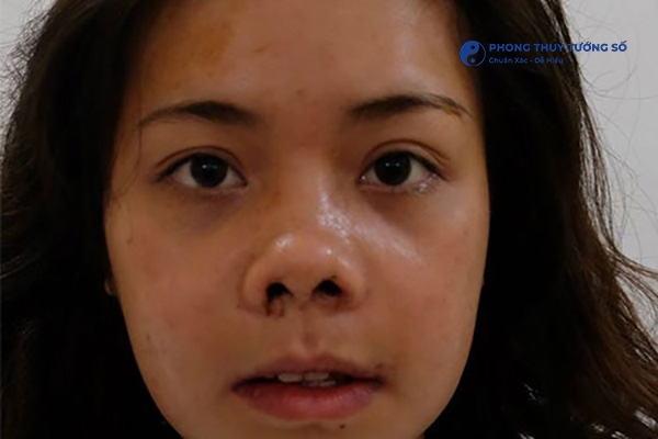 Mũi hỉnh do phẫu thuật thẩm mỹ thất bại