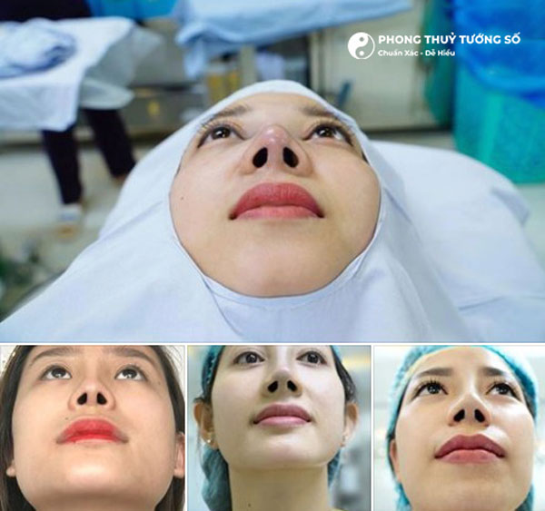 Tạo hình lỗ mũi hạt chanh đẹp bằng phương pháp thẩm mỹ