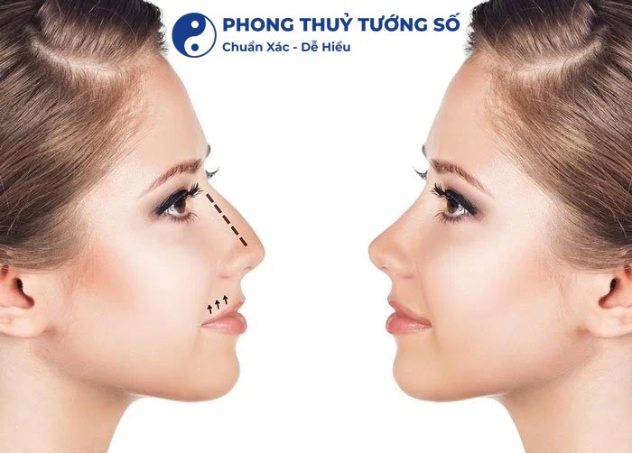 Tướng mũi gồ sẽ như thế nào?