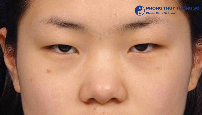 Mắt một mí hình thành do đâu?